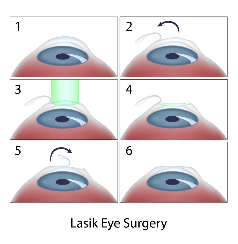 diagram showing six steps of lasik eye surgery