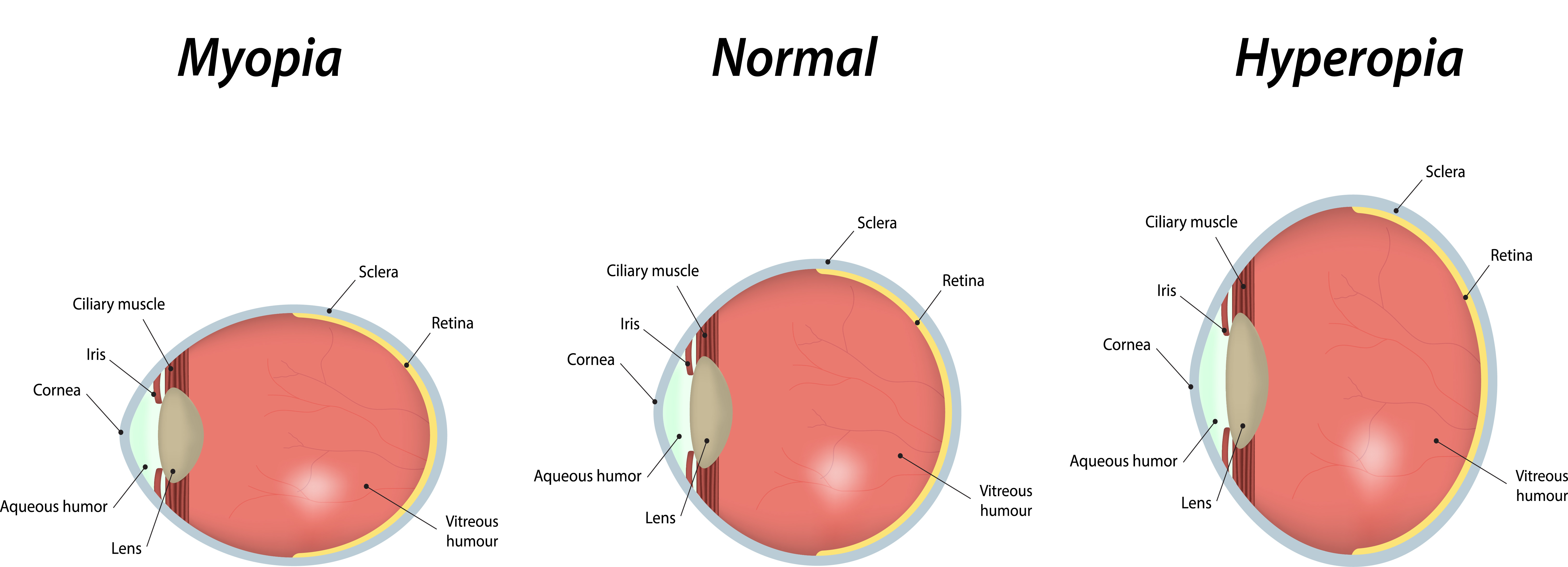 graphic comparing normal vision, myopia refractive error, and hyperopia refractive error