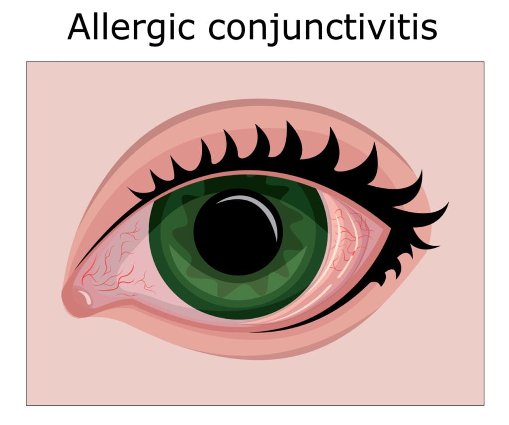 Allergic conjunctivitis