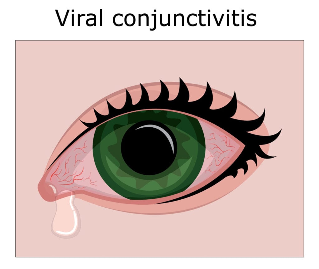 Viral conjunctivitis illustration