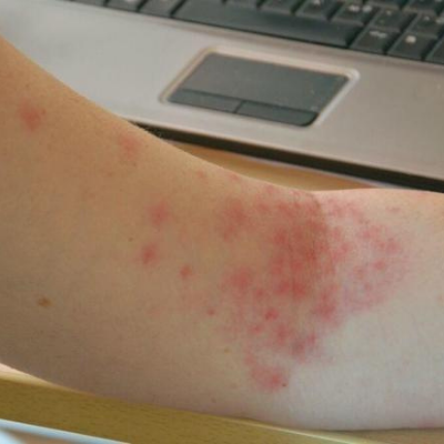 Petechiae photo 1