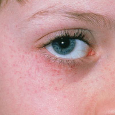 Petechiae photo 5