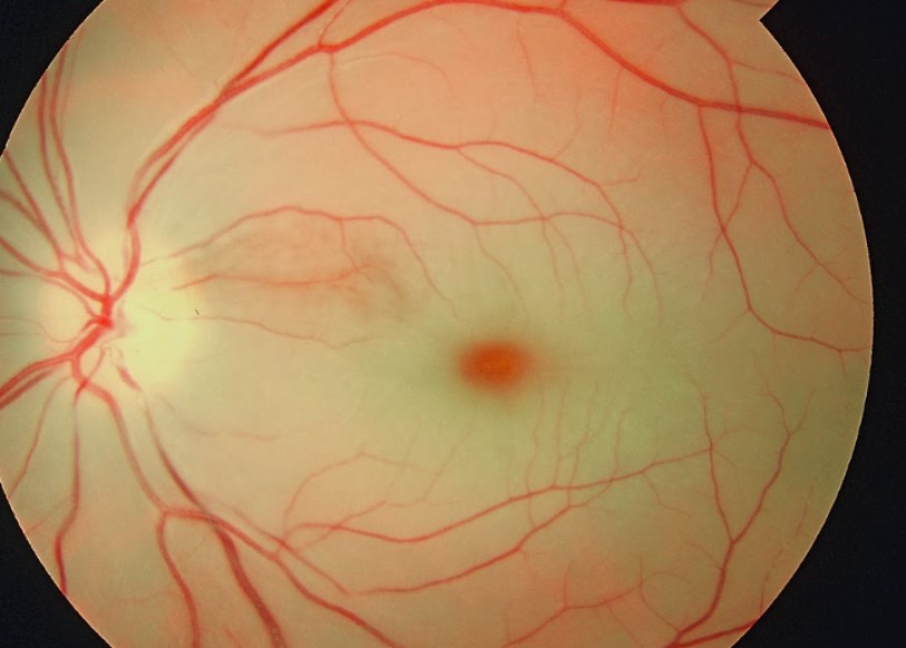 Cherry red spot fundus photo