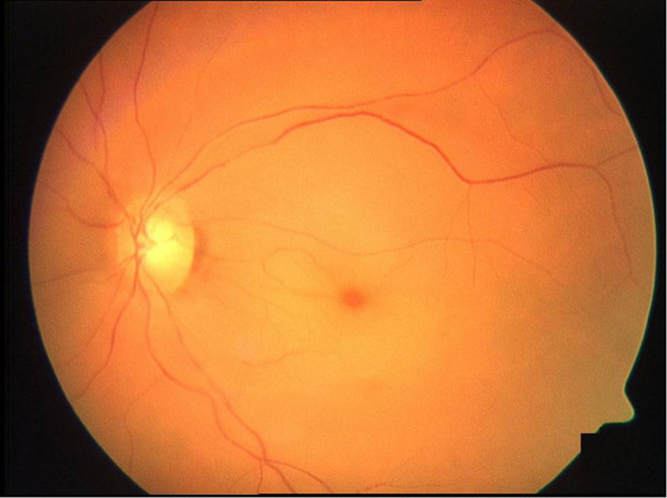 Cherry red spot fundus photo