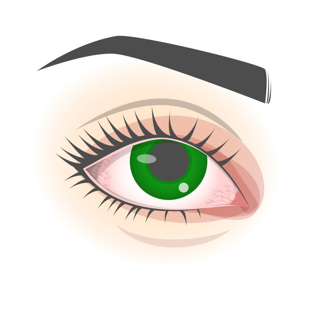 Corneal Abrasion: Understanding Scratched Cornea illustration