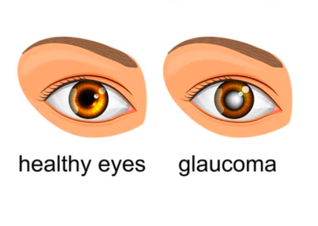 Glaucoma Surgery