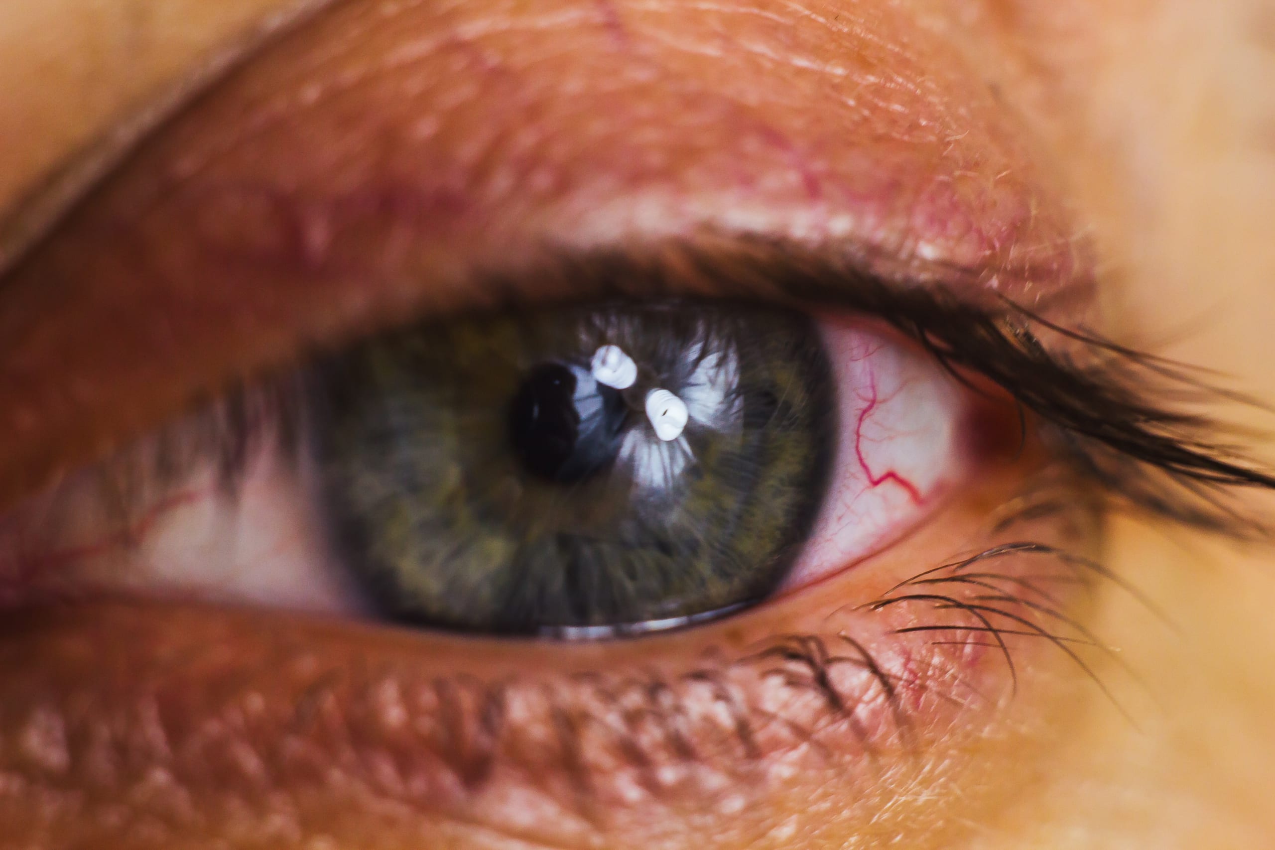 Crying Blood (Haemolacria): Causes & Treatment