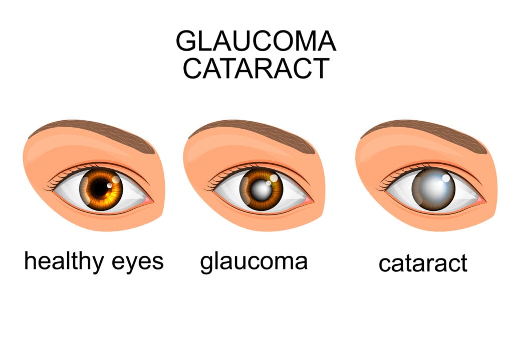 Refractive errors illustration