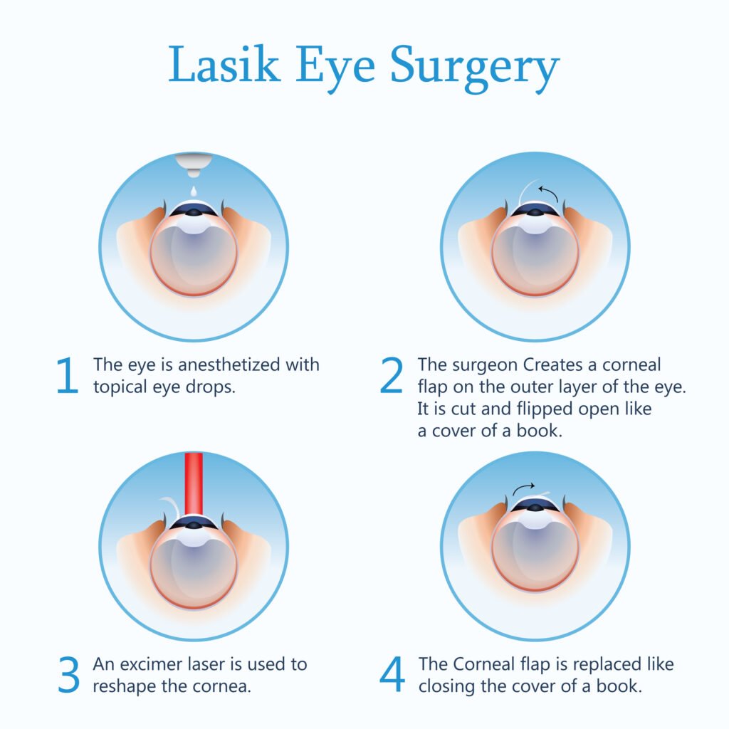 Laser eye surgery illustration