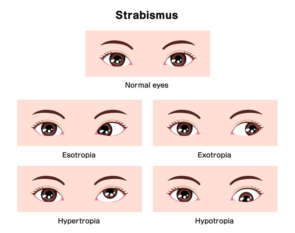 Types of strabismus illustration