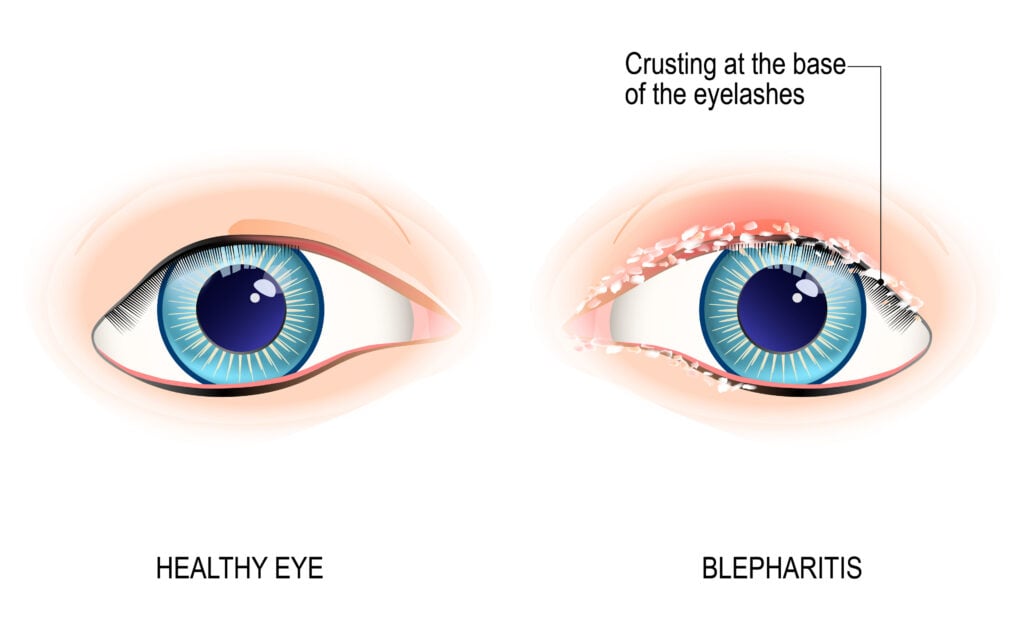 Blepharitis illustration