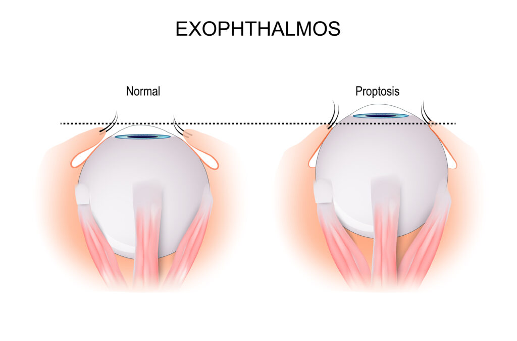 Exophthalmos is a bulging of the eye anteriorly out of the eyelid
