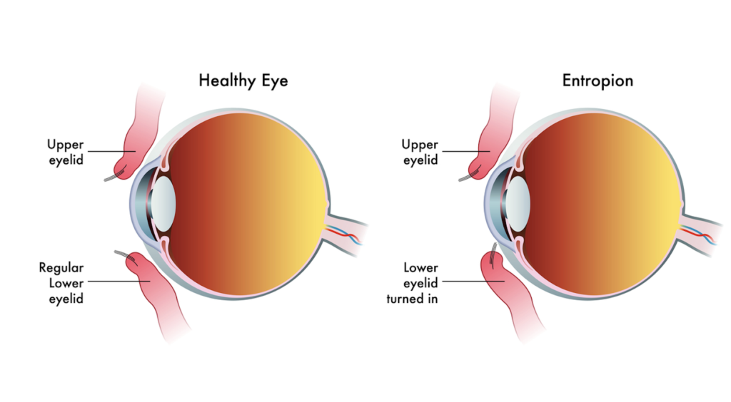 Healthy Eye vs Entropion Illustration