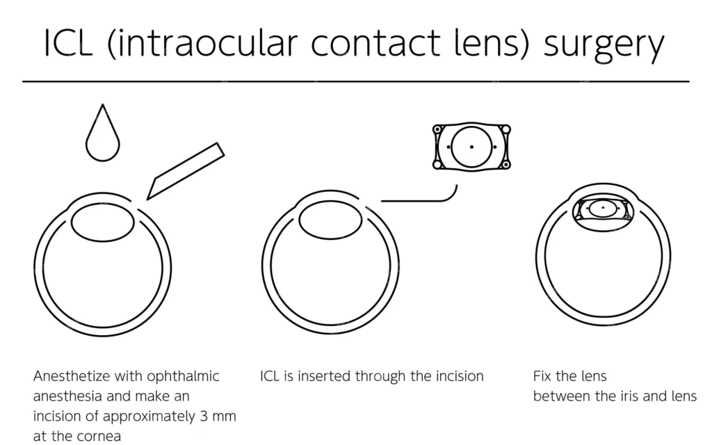 ICL or Intraocular Contact Lens Surgery Illustration