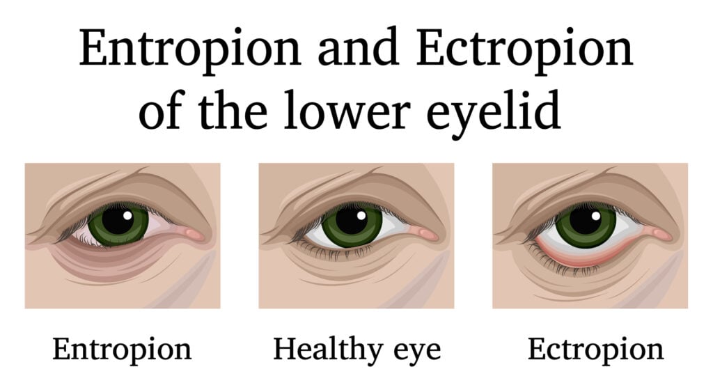 Illustration of Ophthalmic Diseases Entropion and Ectropion of the Eye