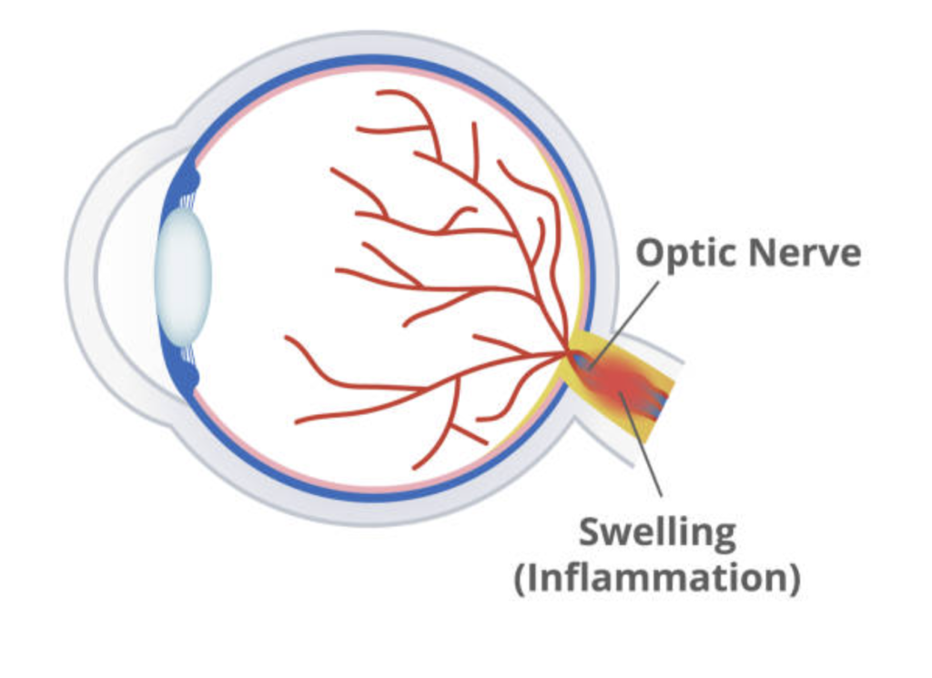 Optic neuritis illustration