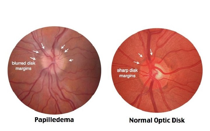 Papilledema vs.. Normal Optic Disk