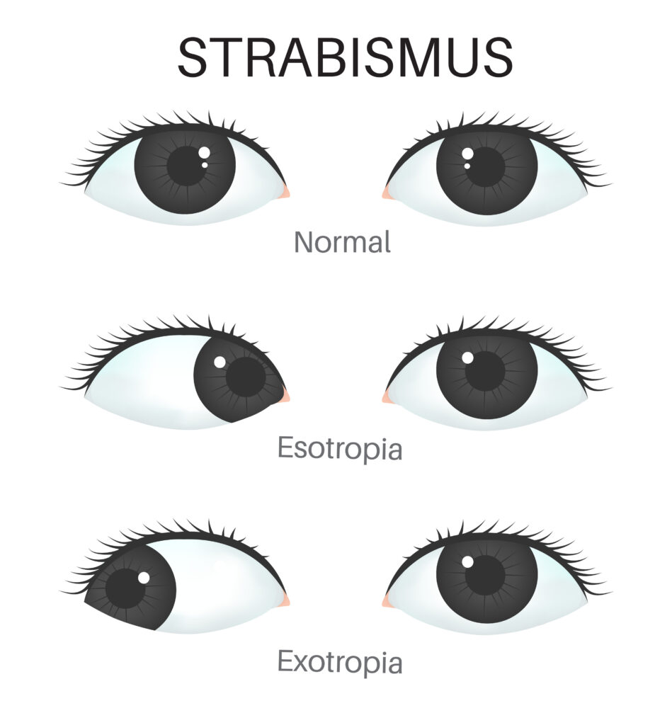 Strabismus in children illustration