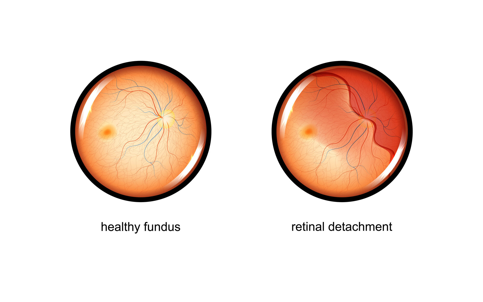 Retinal detachment illustration