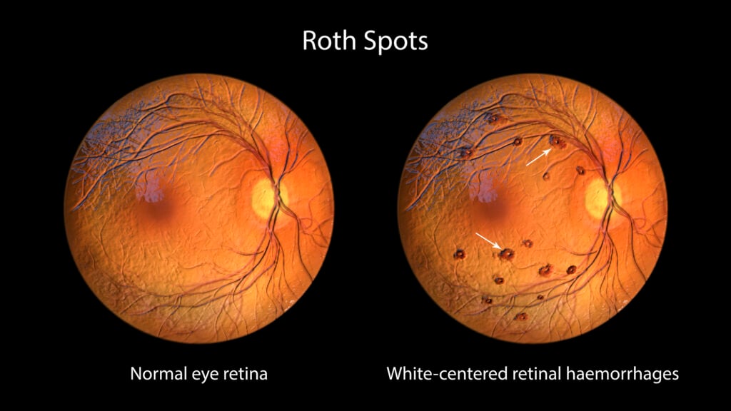 A microscopic representation of roth spots in the retina seen during ophthalmoscopy