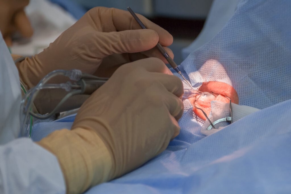 Bimanual Cataract Extraction with IOL Implantation Photo
