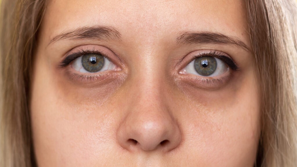 Shot of dark circles under the green eyes of a young woman
