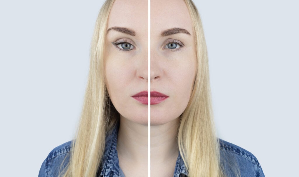 Eyelift Surgery before and after Comparison