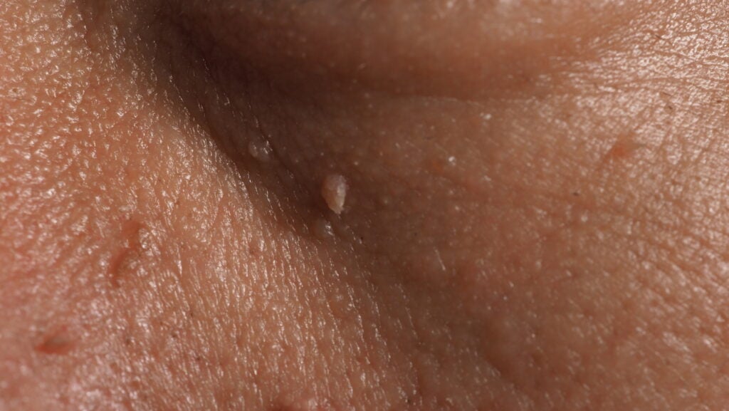 Macro photo of skin tags under an eye