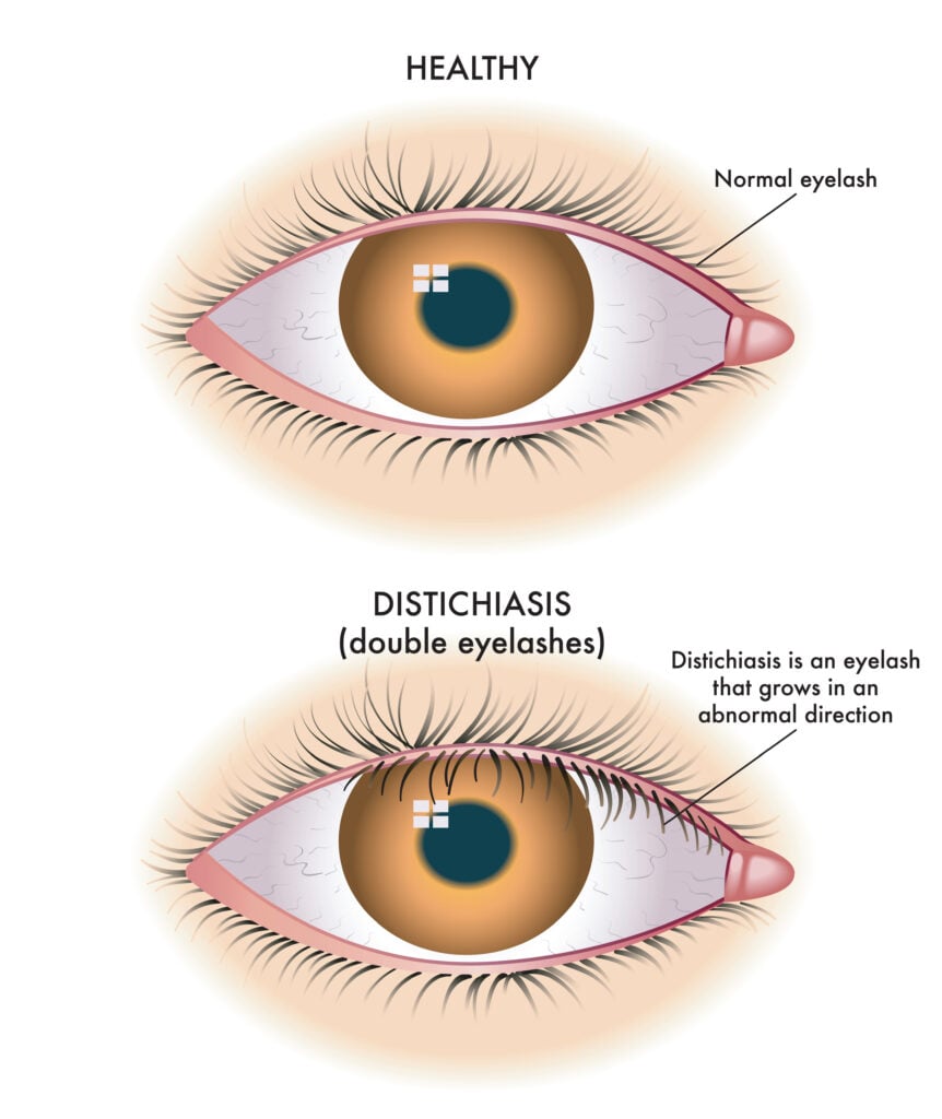 Distichiasis illustration