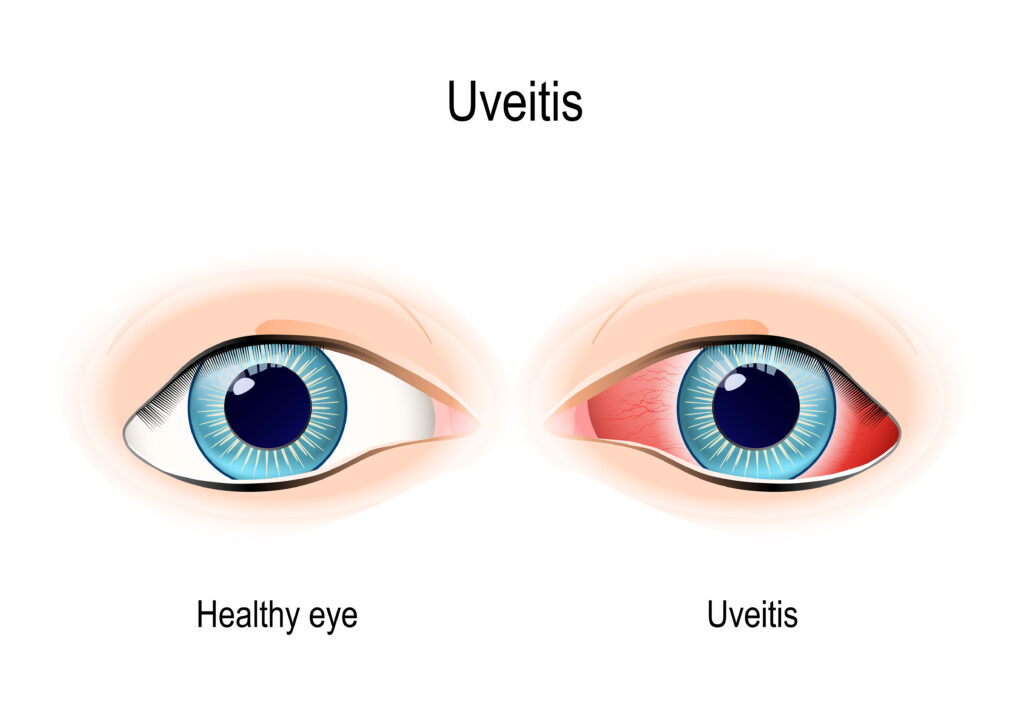 Normal eye vs. uveitis illustration