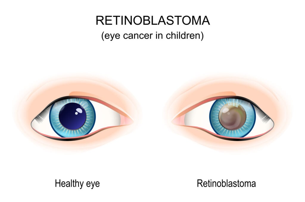 Retinoblastoma illustration