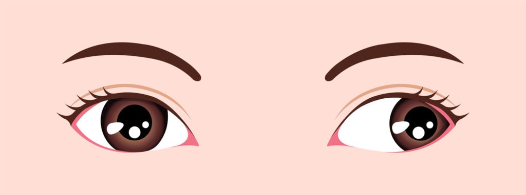 Exotropia strabismus illustration