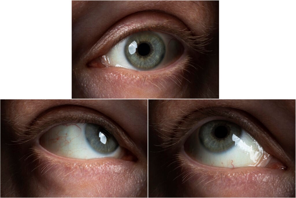 The eye of an adult male in three different positions due to weak eye muscles or ophthalmoplegia