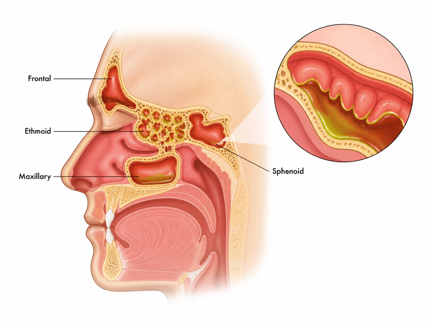 Sinusitis vector illustration