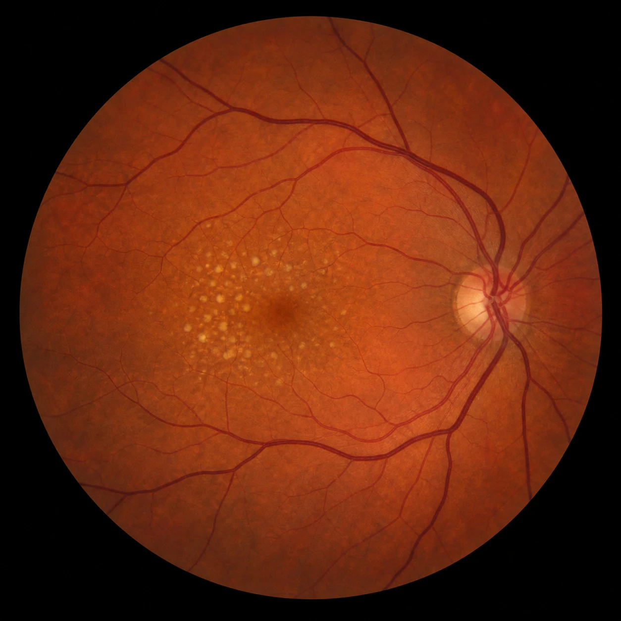 Macular drusen medical photo