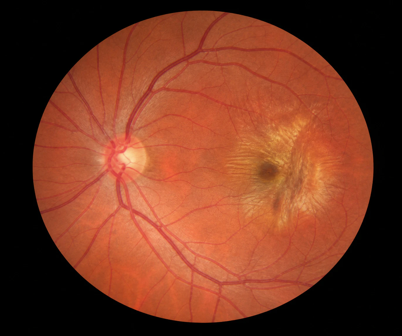 Fundus photo of macular scarring or macular puckering medical image