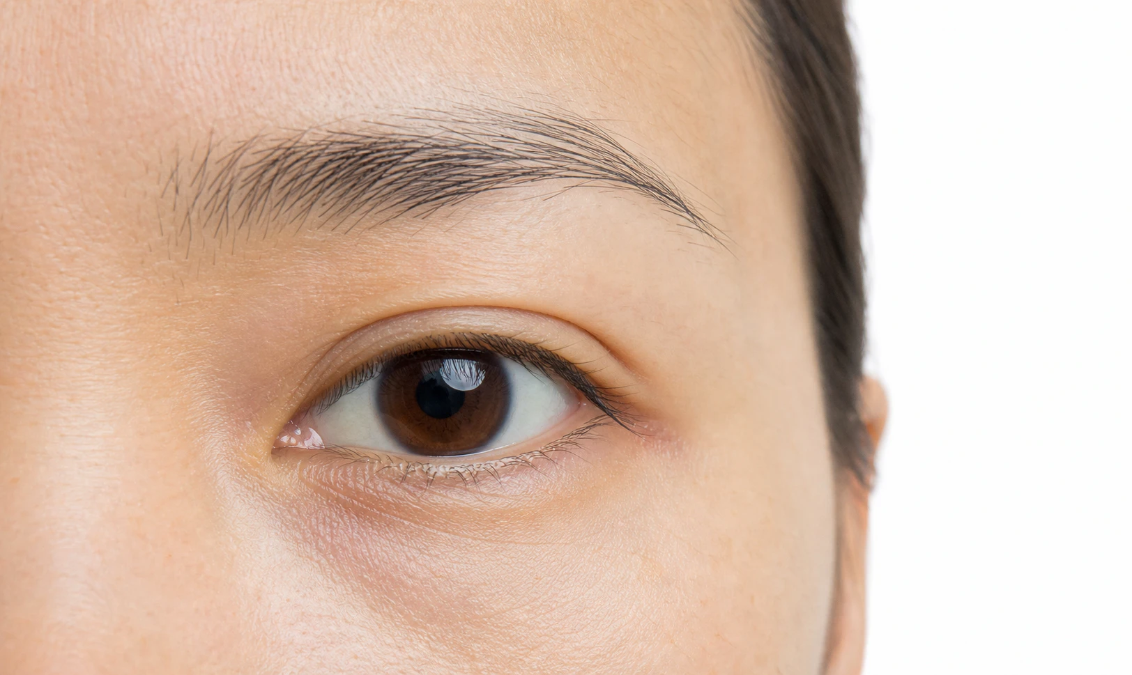 Double eyelid example