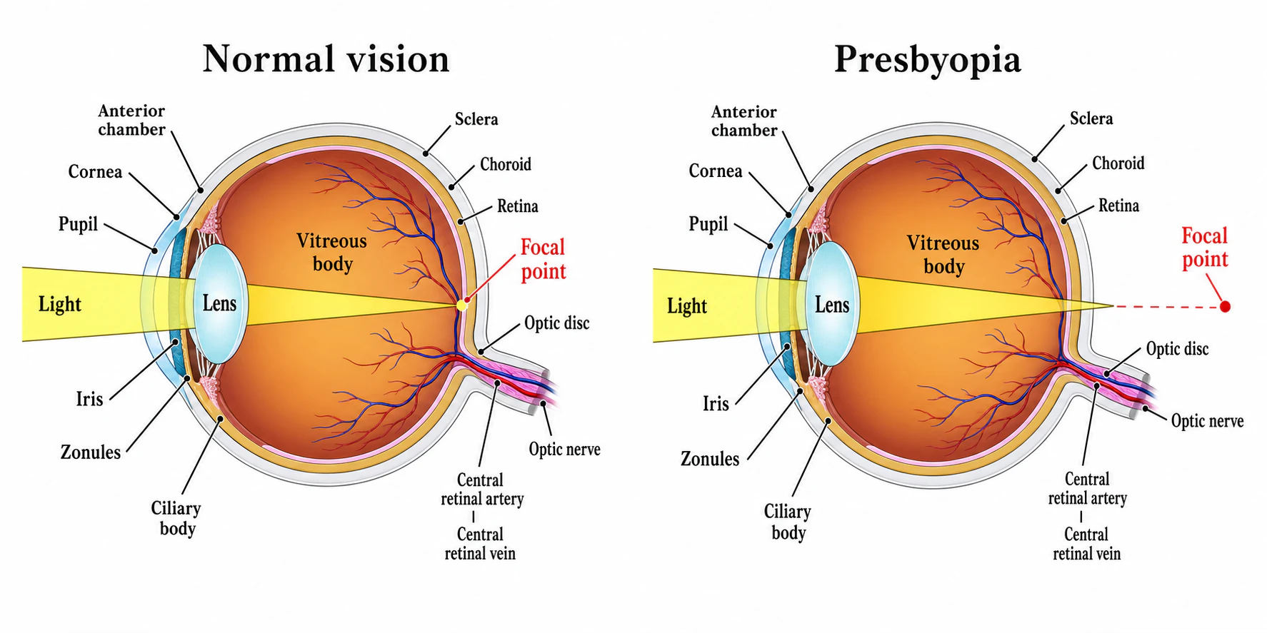 graphic showing normal eye and presbyopia