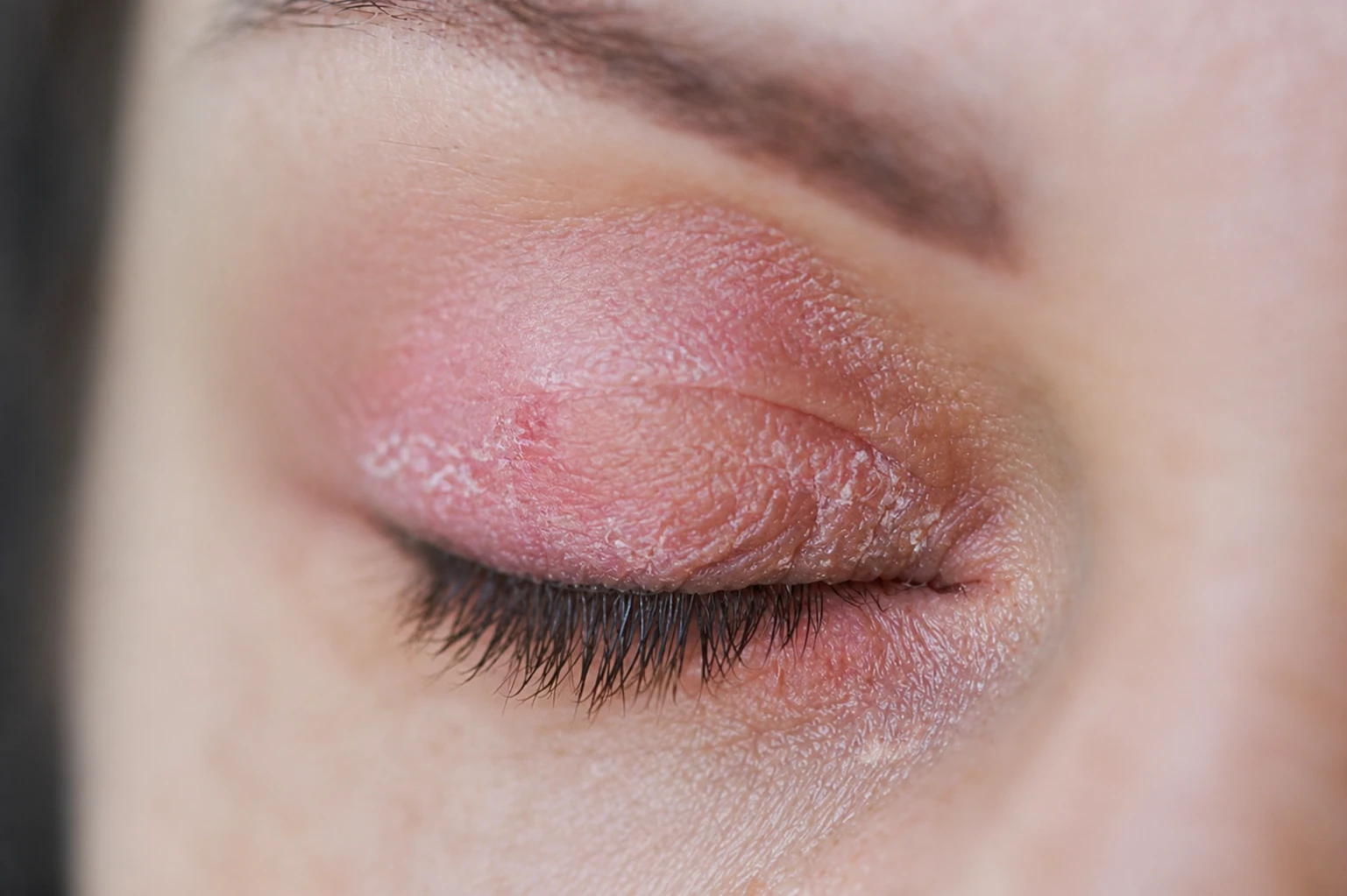 Peeling and swelling on the eyelid of the human eye due to eyelid psoriasis