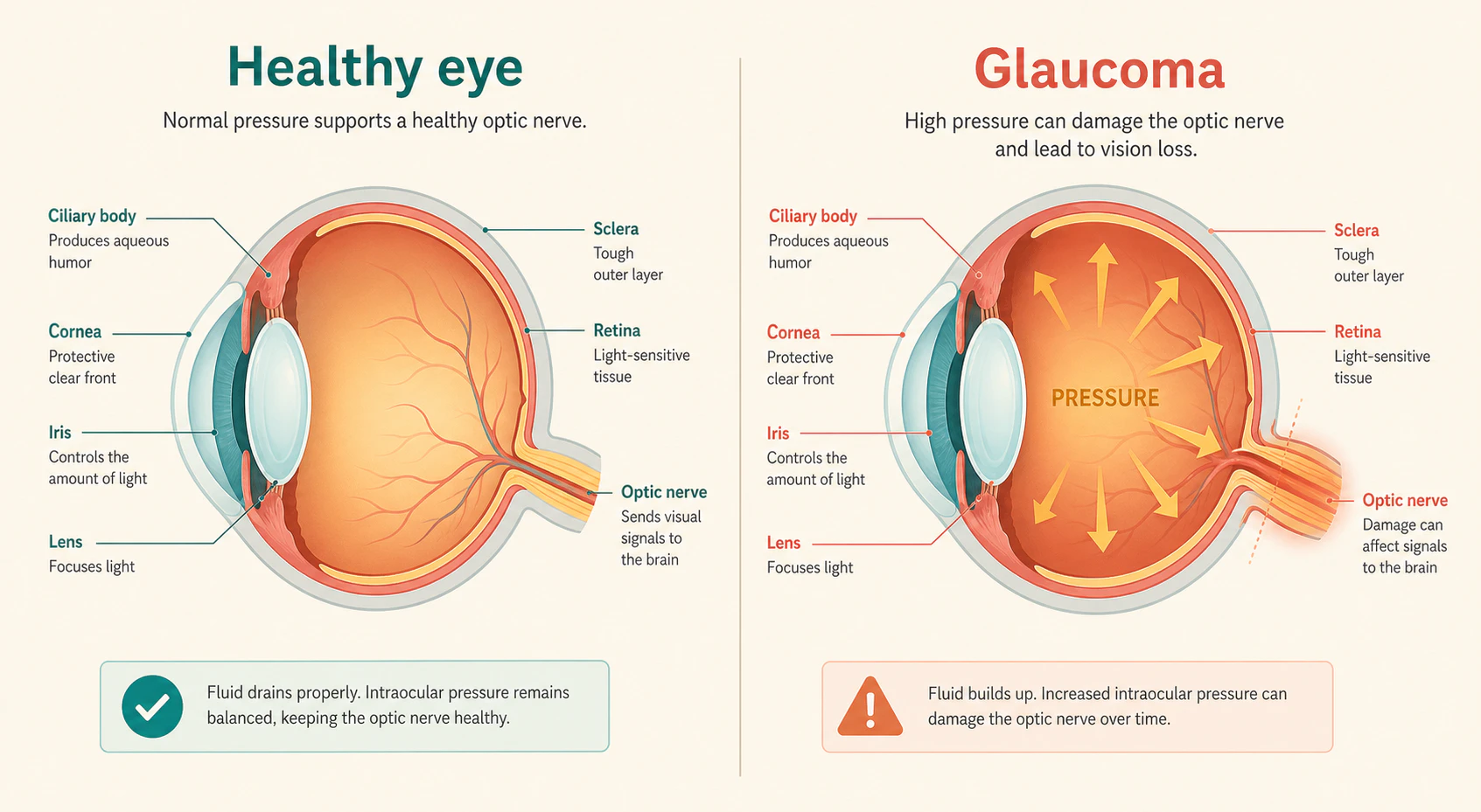 How glaucoma develops - Healthy Eye vs Eye with Glaucoma
