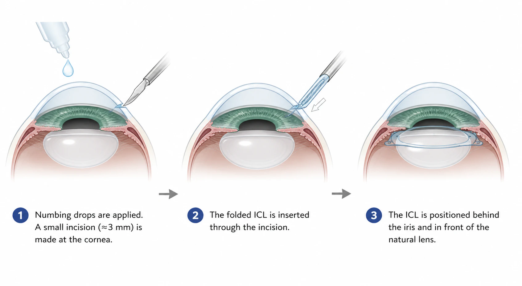 ICL or Intraocular Contact Lens Surgery Illustration