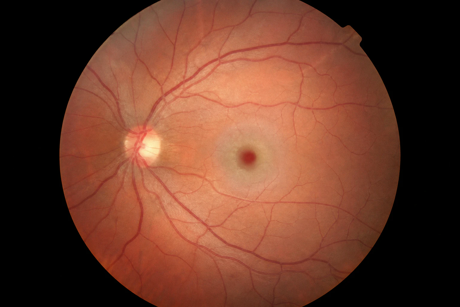 Cherry red spot fundus photo