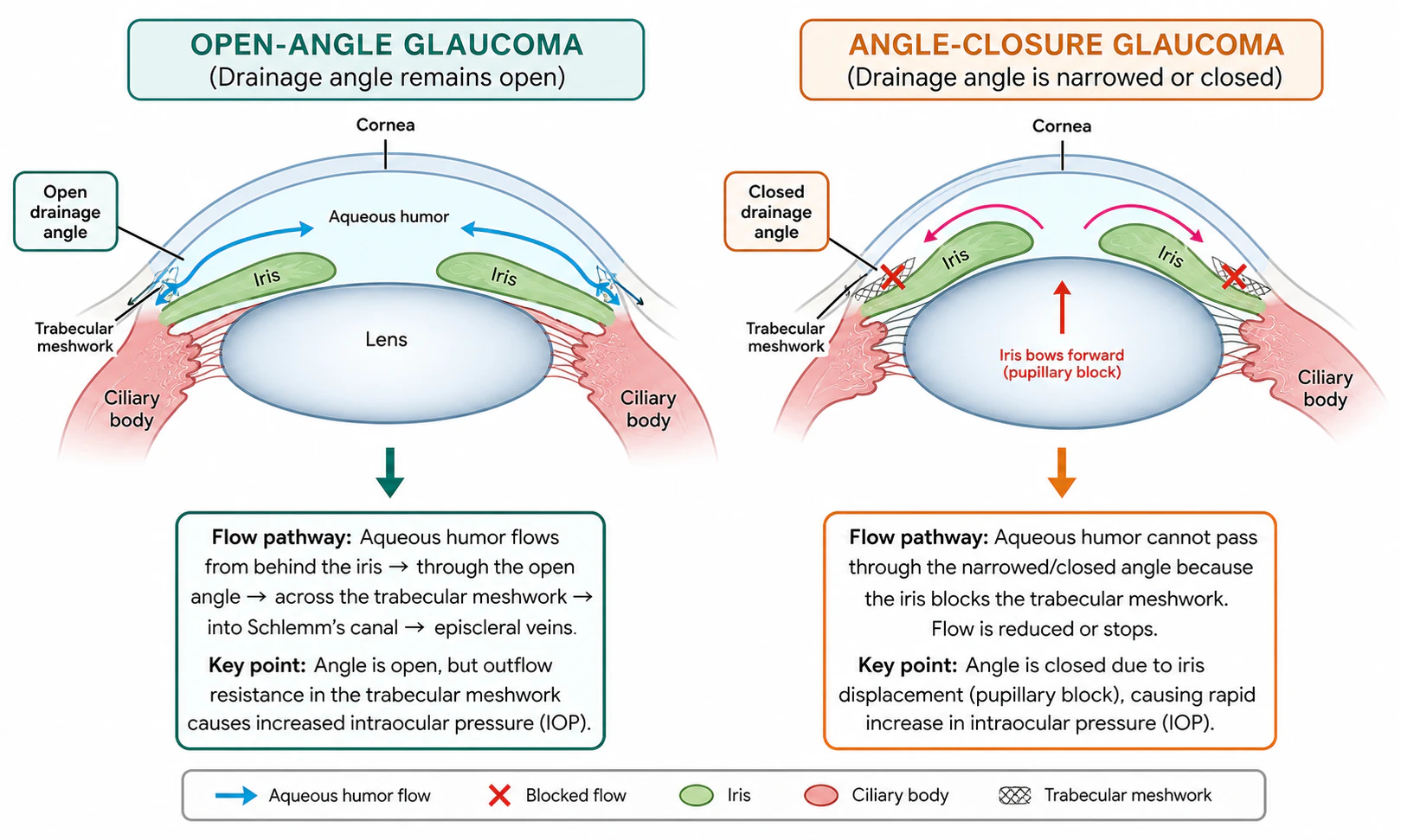 Open-angle vs. angle-closure glaucoma illustration