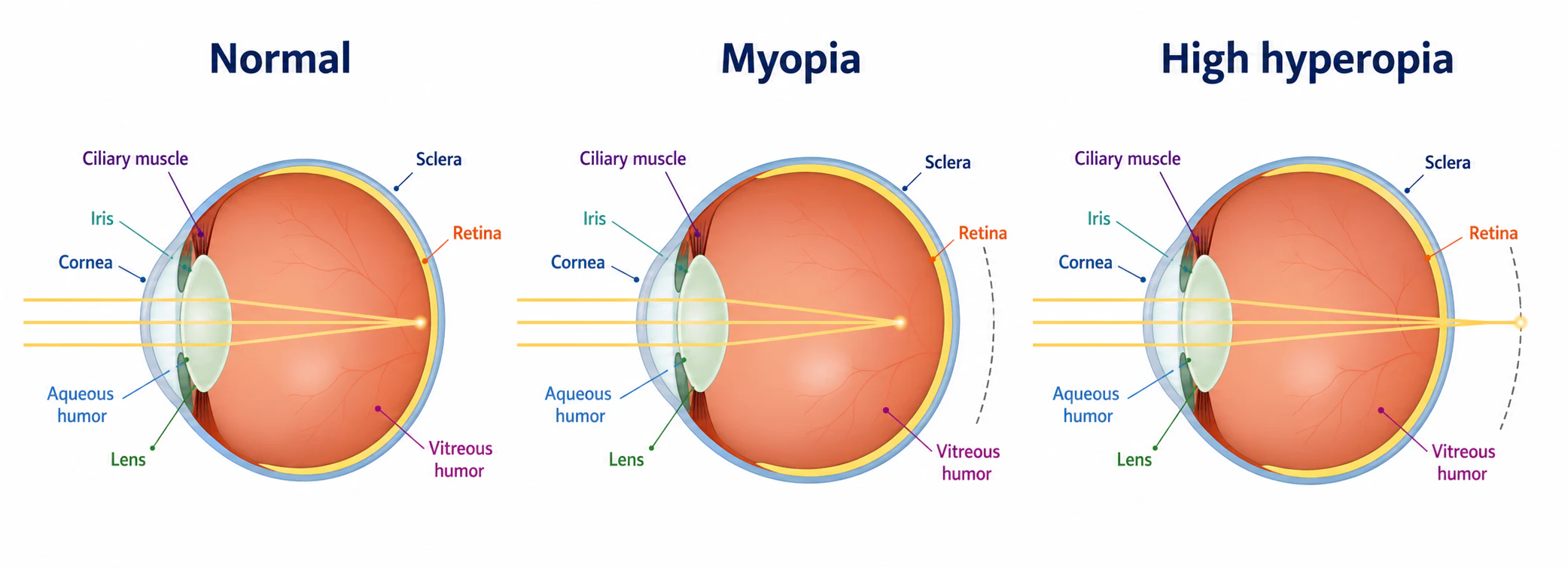 Eye surgery patient in a hospital setting