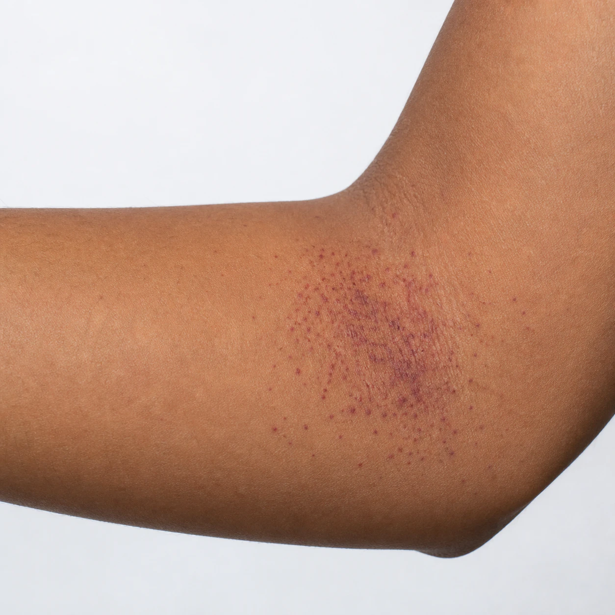 Petechiae photo 1