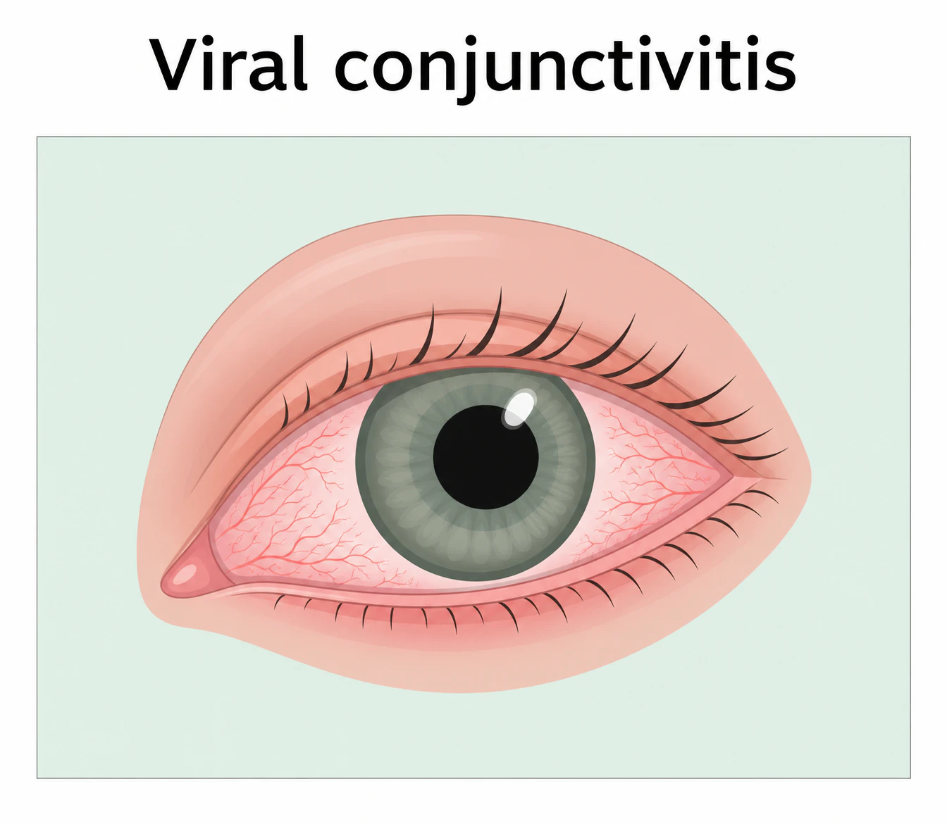 viral conjunctivitis