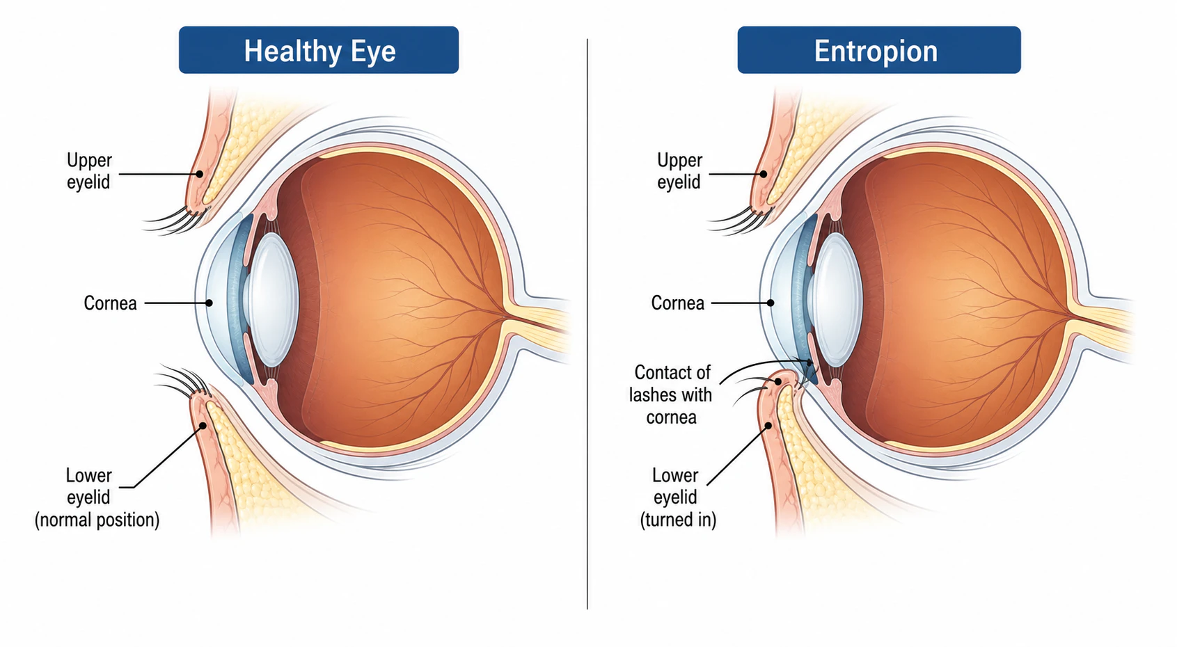 Healthy Eye vs Entropion Illustration