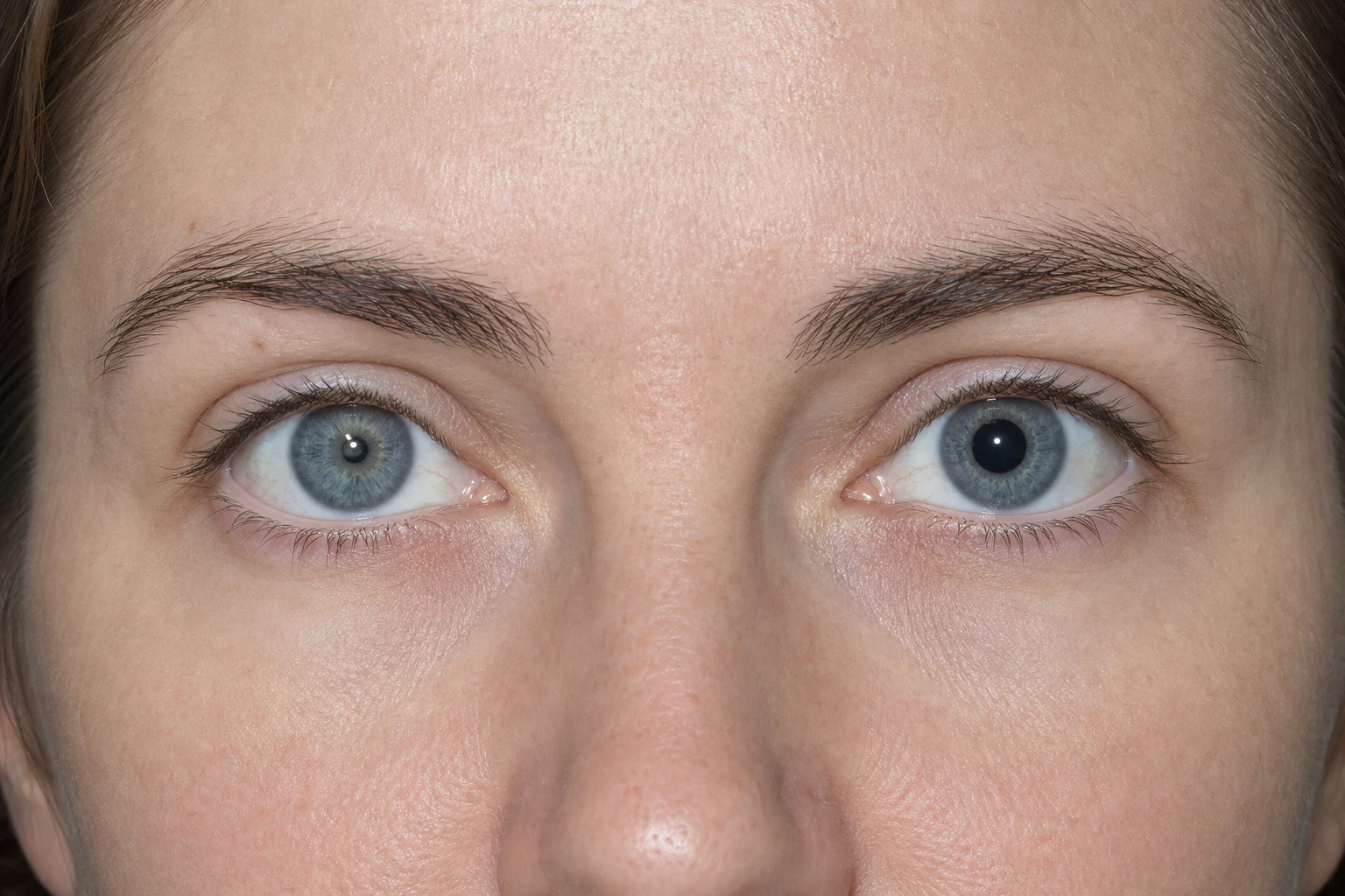 Anisocoria (Unequal Pupil Sizes): Causes & Treatments