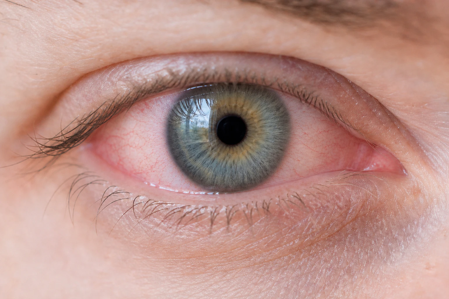 Conjunctivitis or pink eye close up on eye