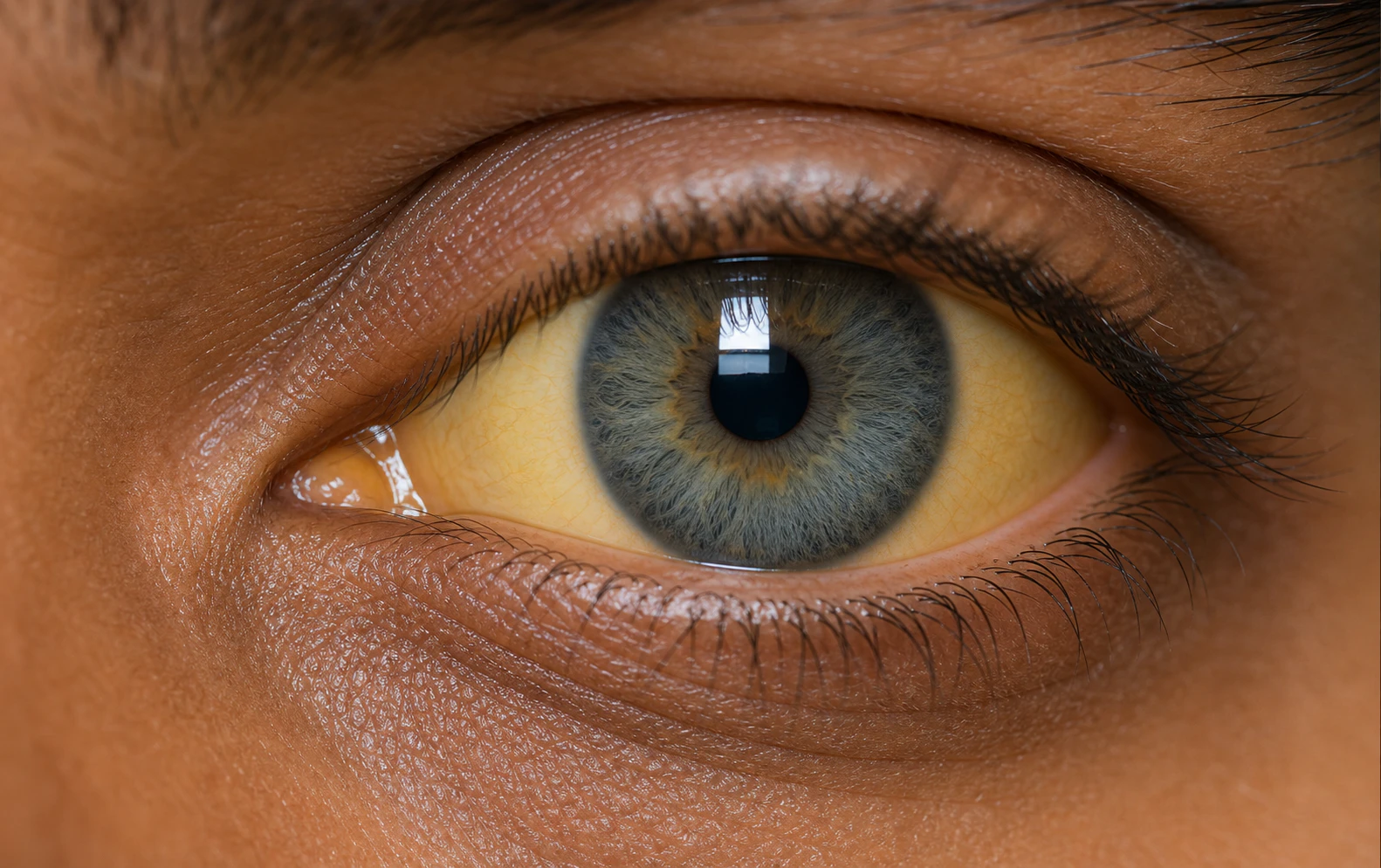 Jaundice eyes